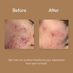 Acne Fighting Arsenal