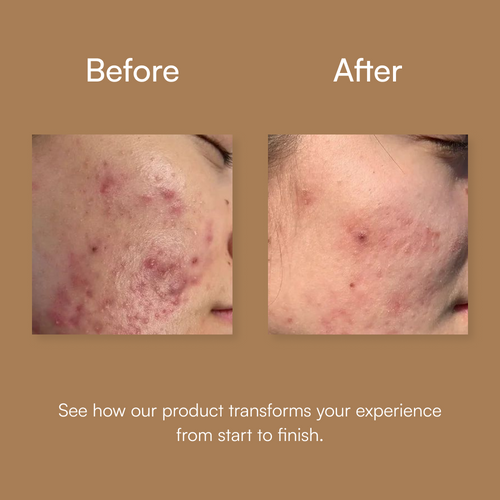 Acne Fighting Arsenal