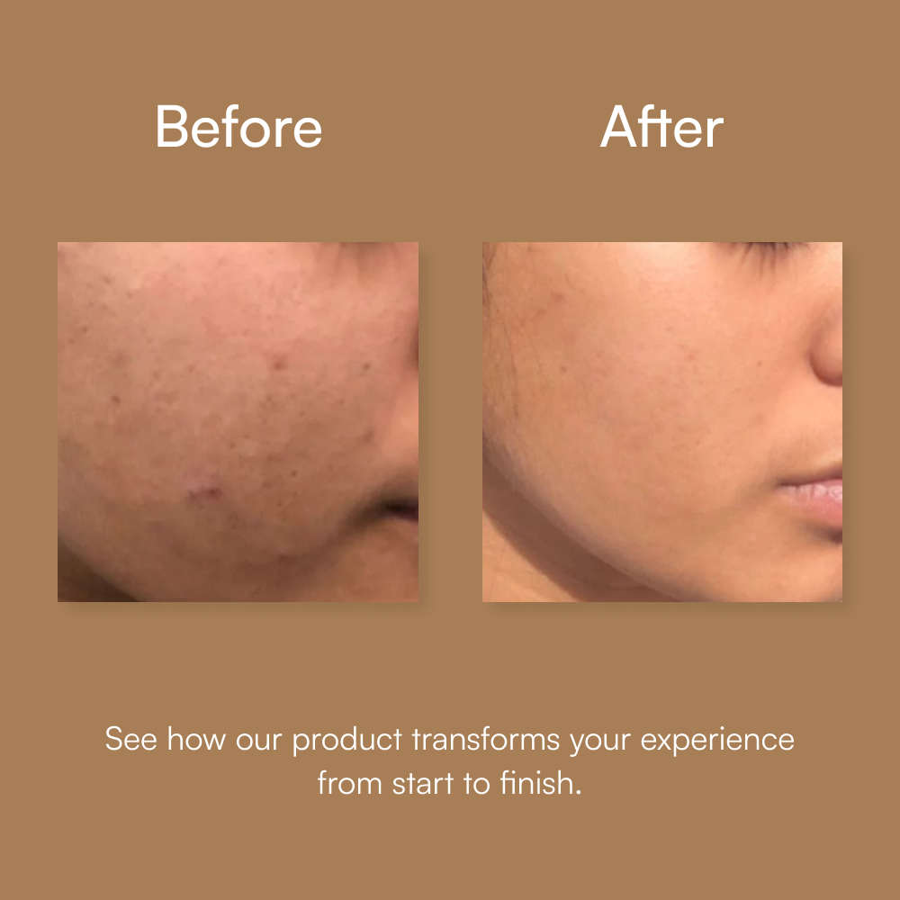 Anti Acne & Oil Control Facewash