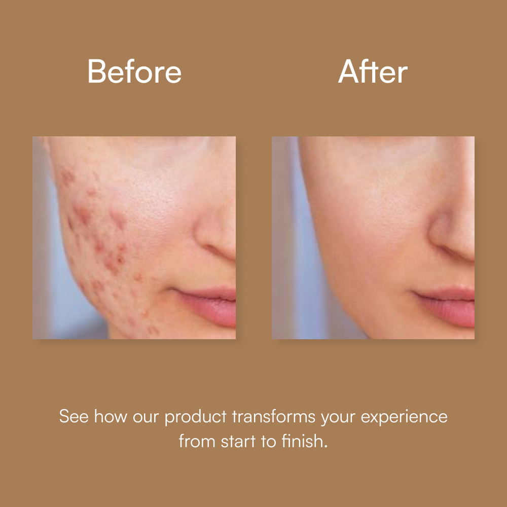 Anti Acne Serum